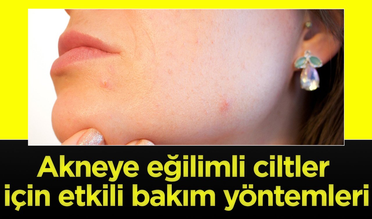  Akneye eğilimli ciltler için etkili bakım yöntemleri