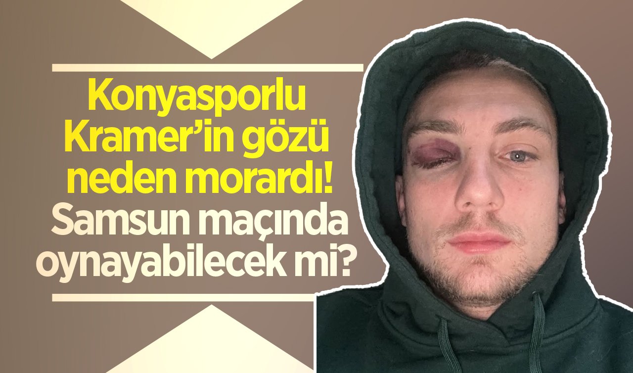 Konyasporlu Kramer’in gözü neden morardı! Samsun maçında oynayabilecek mi? 